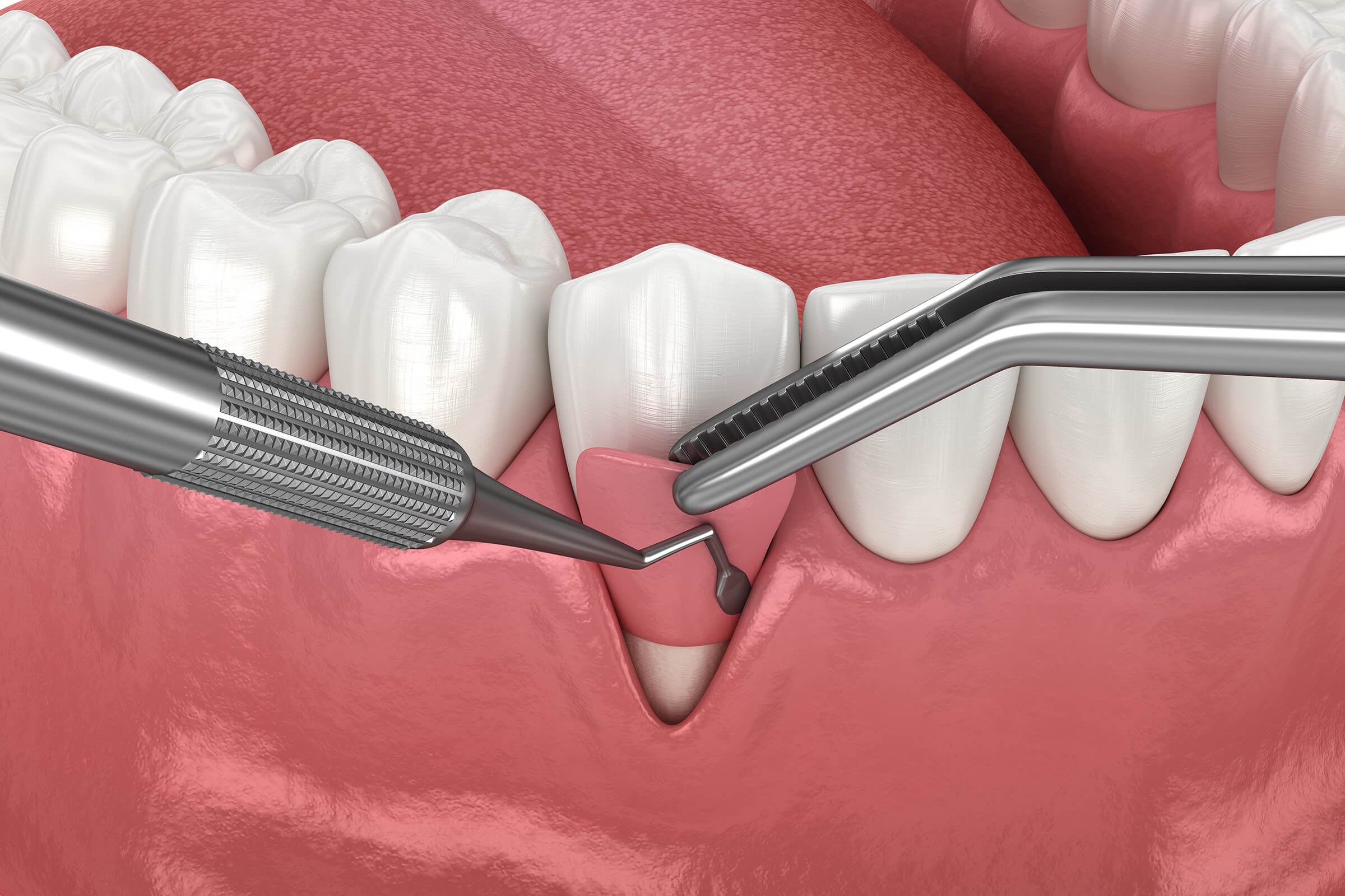 تجميل وعلاج اللثة